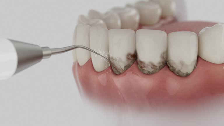 Trusted Dental Crowns And Bridges service in Raleigh, NC - Dentist Open Now